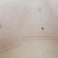 
	Flexural lichen planus