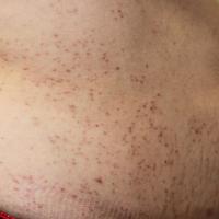 
	Lichen planus on the trunk