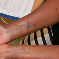 
	Lichen planus&nbsp;
	
	In skin of…
