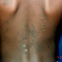 
	Lichen planus
	
	The lower back is a commonly…