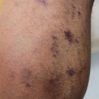 
	Lichen planus, post-inflammatory

	At this…