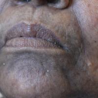 
	Lichen planus pigmentosus

	Affecting the face…