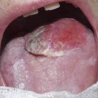 
	Lichen planus and squamous cell…