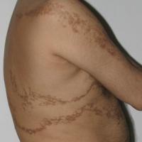 Blaschkoid lichen planus

The rash was itchy…