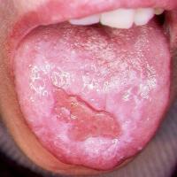 
	Erosive lichen planus