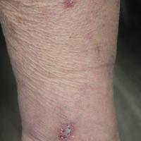 
	Lichen planus / discoid lupus erythematosus…