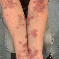Lichen planus - not usually scaly
