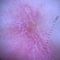 Same patient as previous figure - the…