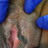 Vulval lichen planus with hyperkeratotic…