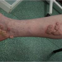 
	Hypertrophic lichen planus - a biopsy was…