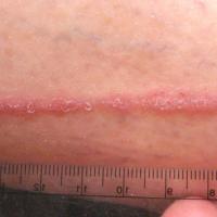 
	Lichen planus and the Koebner phenomenon