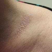 
	Non-genital lichen sclerosus - classical…
