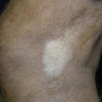 
	Lichen sclerosus in a scar