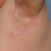 
	Non-genital lichen sclerosus in the axilla