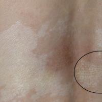 
	Non-genital lichen sclerosus with pitting…