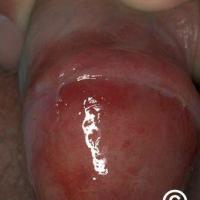 Lichen sclerosus with glistening erythema
In the…