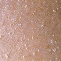 
	Multiple minute digitate hyperkeratosis
