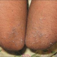 
	Phrynoderma