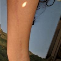 
	Lichen striatus - inflammatory phase

	&nbsp;