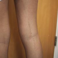 Same patient as previous image
In skin of colour…