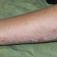 
	An inflammatory linear verrucous epidermal…