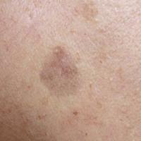 
	Lichenoid keratosis