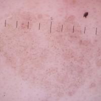 
	Dermoscopic appearance of previous image