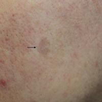 
	Lichenoid keratosis 
