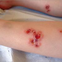 
	Chronic bullous disease of childhood