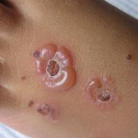 
	Chronic bullous disease of childhood
