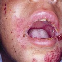 
	Chronic bullous disease of childhood