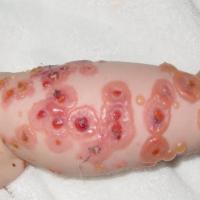 
	Chronic bullous disease of childhood