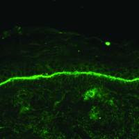 
	Linear IgA disease of adults

	Direct…