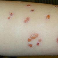 
	Linear IgA disease of adults