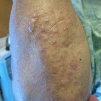 
	Linear IgA disease of adults, secondary to…