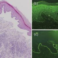
	Chronic bullous disease of childhood

	(a)…