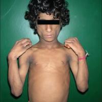 
	Generalised congenital lipodystrophy

	Original…