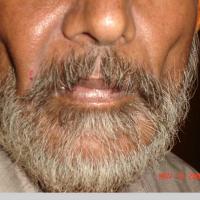 
	Lipodystrophy secondary to antiretroviral…