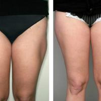 
	Lipoatrophy secondary to growth hormone…