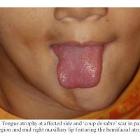 
	Progressive hemifacial atrophy - tongue…