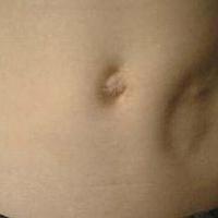 
	Lipoatrophy secondary to insulin injections