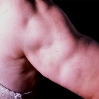 Lipoatrophic panniculitis 