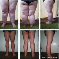
	Lipoedema

	Bottom images post…