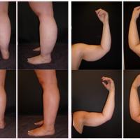 
	Lipoedema

	Bottom images post…