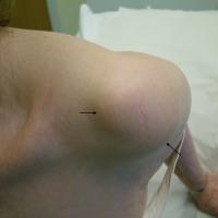 
	Lipoma

	Arrows denote margins