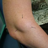 
	Lipoma