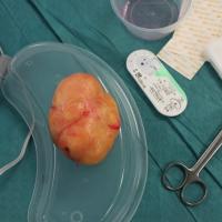 
	Lipoma - excised 