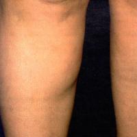 
	Dercum's disease&nbsp;