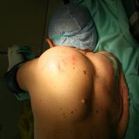
	Liposarcoma (non-cutaneous)