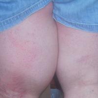 
	Liposarcoma (non-cutaneous)